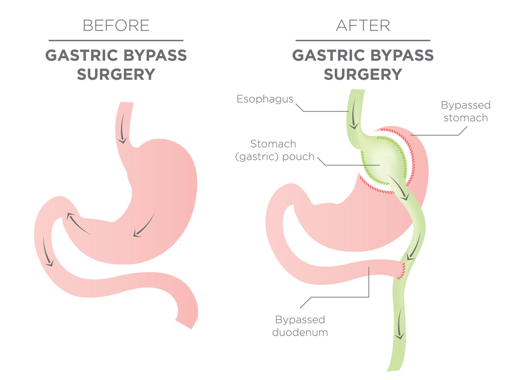 Gastric Bypass in Singapore